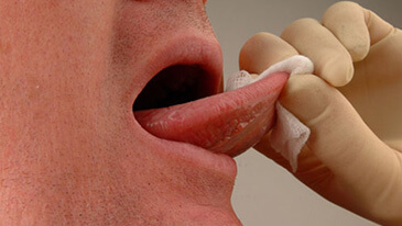 Tounge disease