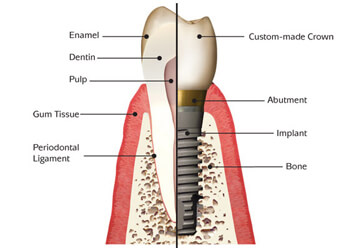 34d486_885329e0c27b474d8a32776c00a9e07c_mv2 | Healthy Smile Centre Rosebery Dental Implants 3