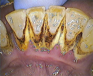 34d486_ebc23292ad2b496f8d626646778d554a_mv2 Teeth Plaque