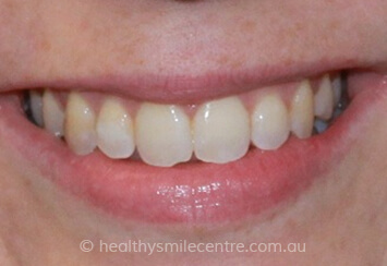 34d486_ed28779382684abbb79bd4563cf92152_mv2 | Healthy Smile Centre Rosebery Unaligned Teeth After