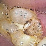 Tooth Plaque